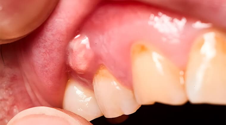 Absceso dental