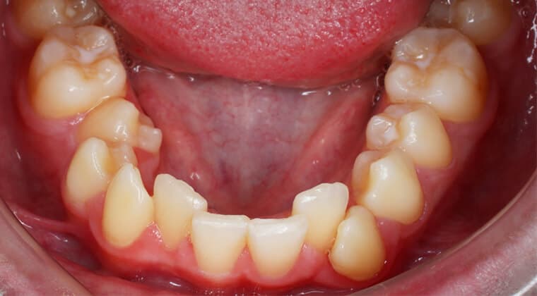 Apiñamiento dental