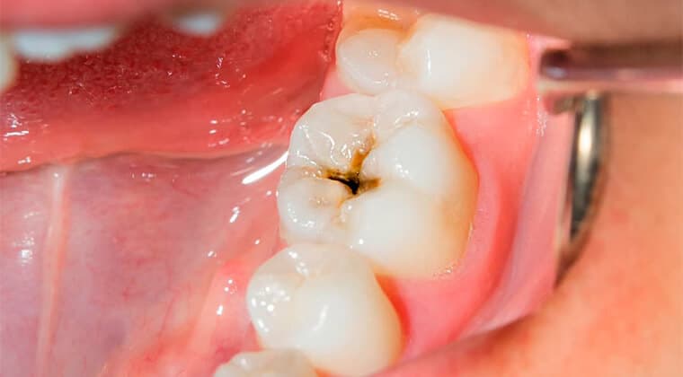 Caries dental