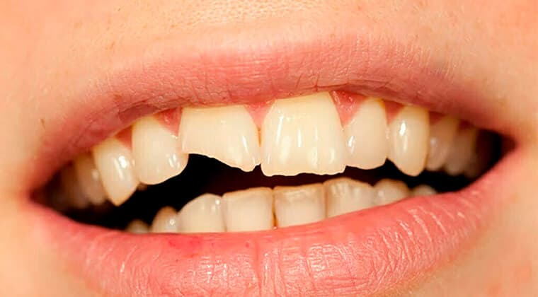 Fractura dental