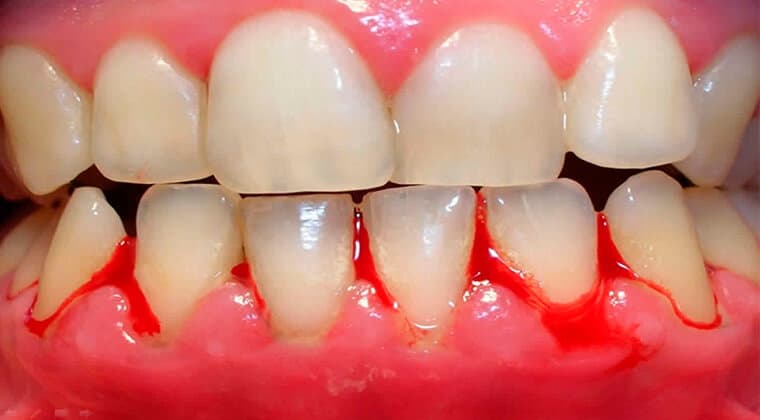 Gingivitis