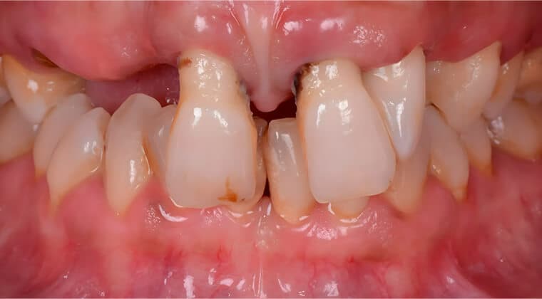 Periodontitis