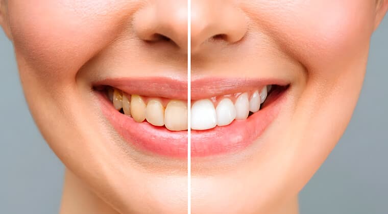 Blanqueamiento dental