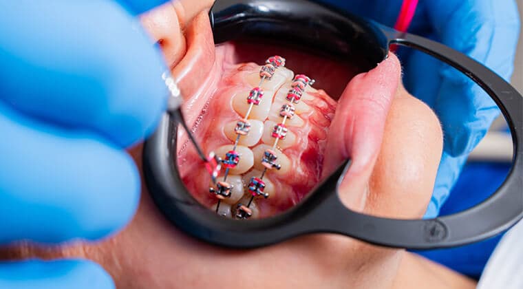 Colocación de brackets