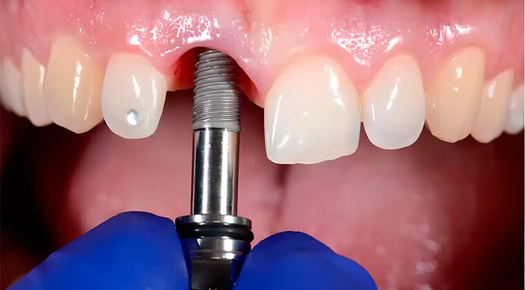 Colocación de implantes dentales