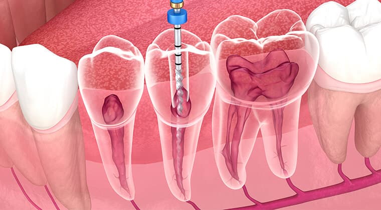 Endodoncia