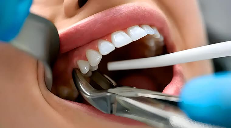 Extracciones dentales